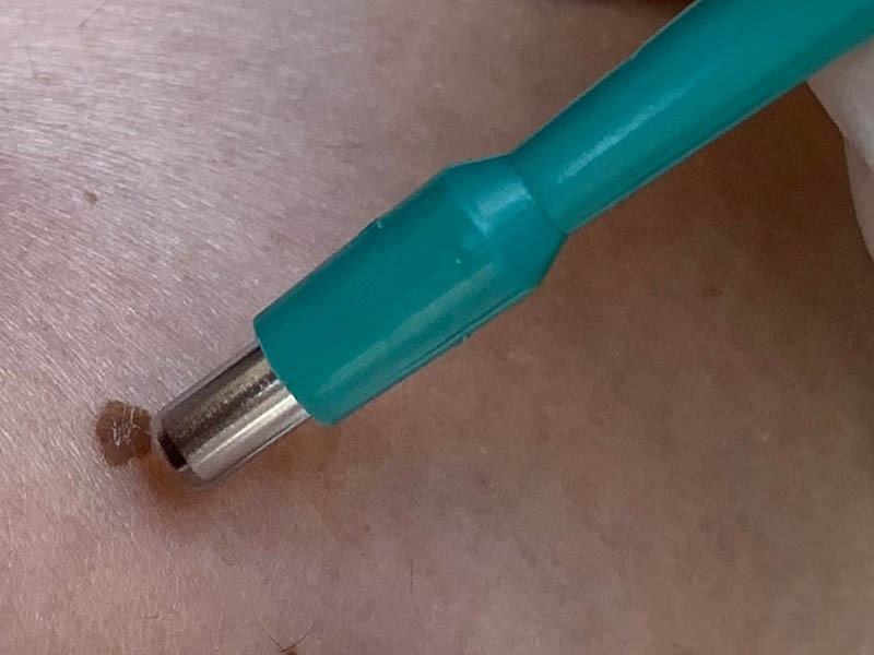 Portable Biopsy Kit